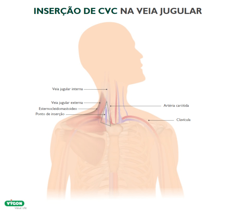 cvc insertion